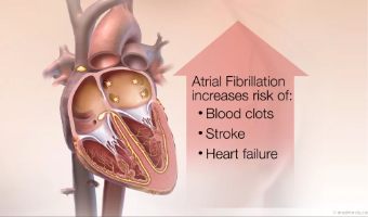Atrial-Fibrillation