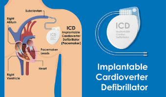 Pacemaker-ICD
